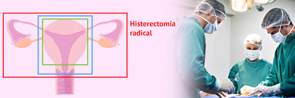 Histerectomia Radical – Acta Cancerológica